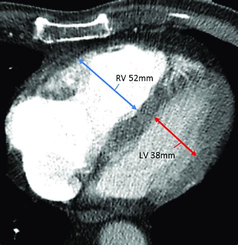 rv lv ratio pulmonary embolism.